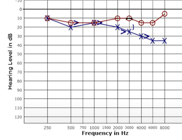 Audiological report chart showing increasing hearing loss in left ear starting at 2kHz and dropping to -35dB at 8kHz.