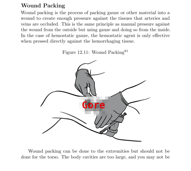 Section on wound packing with an accompanying figure showing procedure.