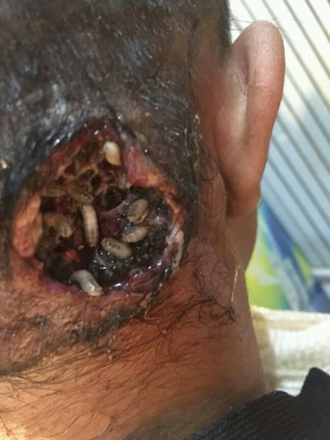 screw worm infestation on the back of a man's head 