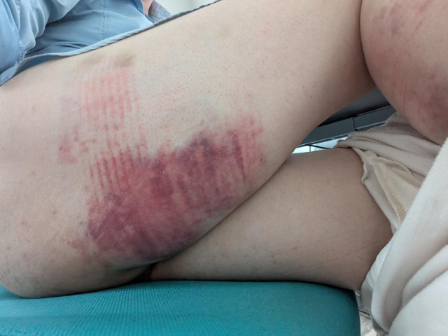 My thigh, with the back of it red and purple with a large bruise crossed with red lines